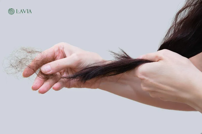 Rụng tóc nhiều ở nữ tuổi 17: Điều gì đang xảy ra?