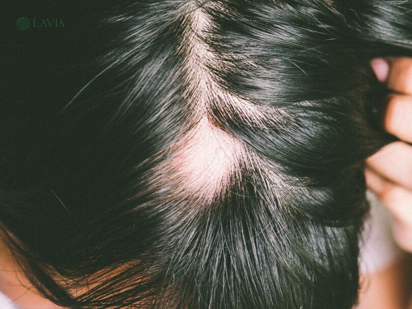 Triệu chứng của rụng tóc tự miễn